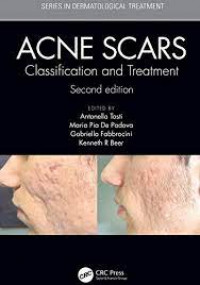 Acne scars: classification and treatment